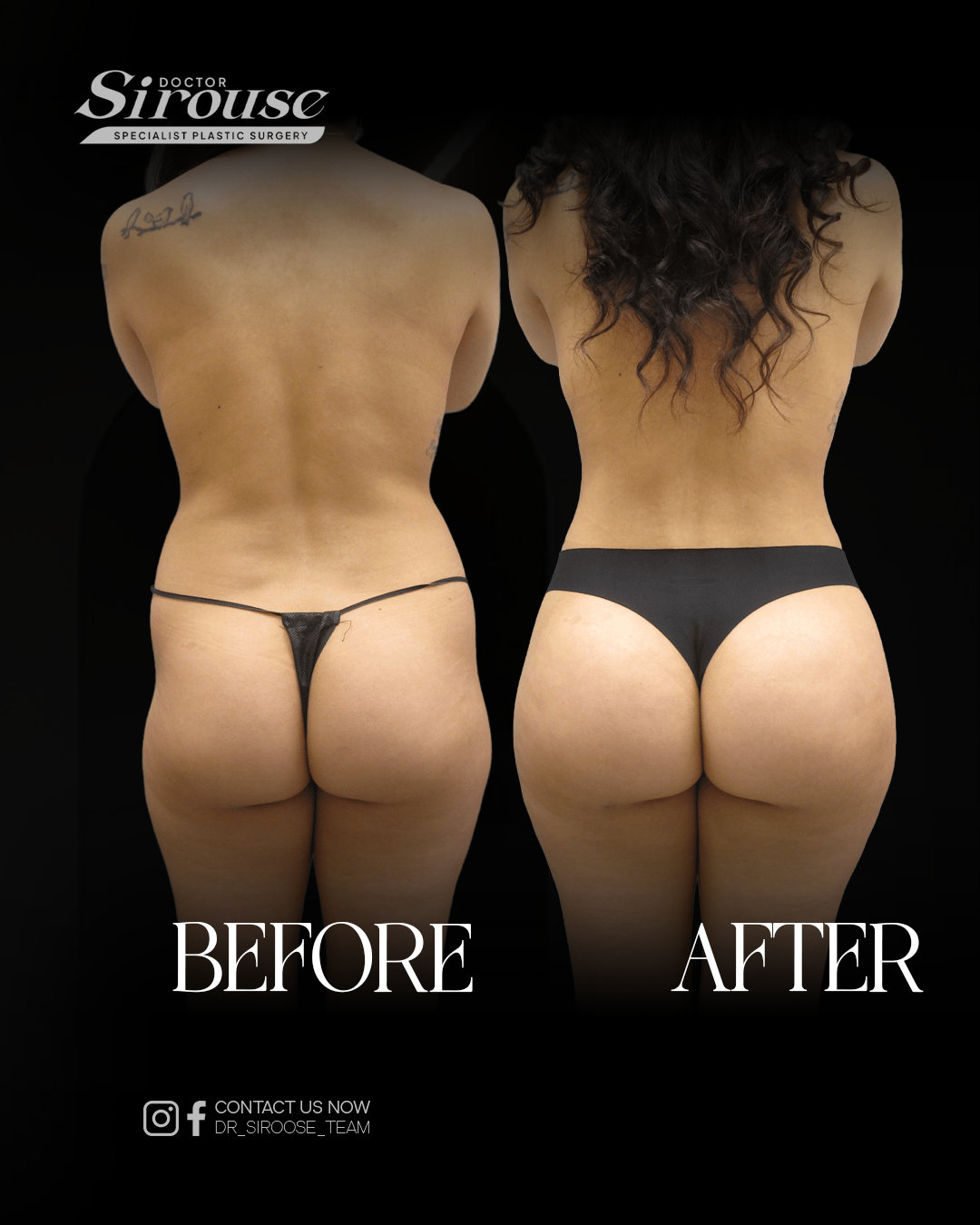Back contouring result