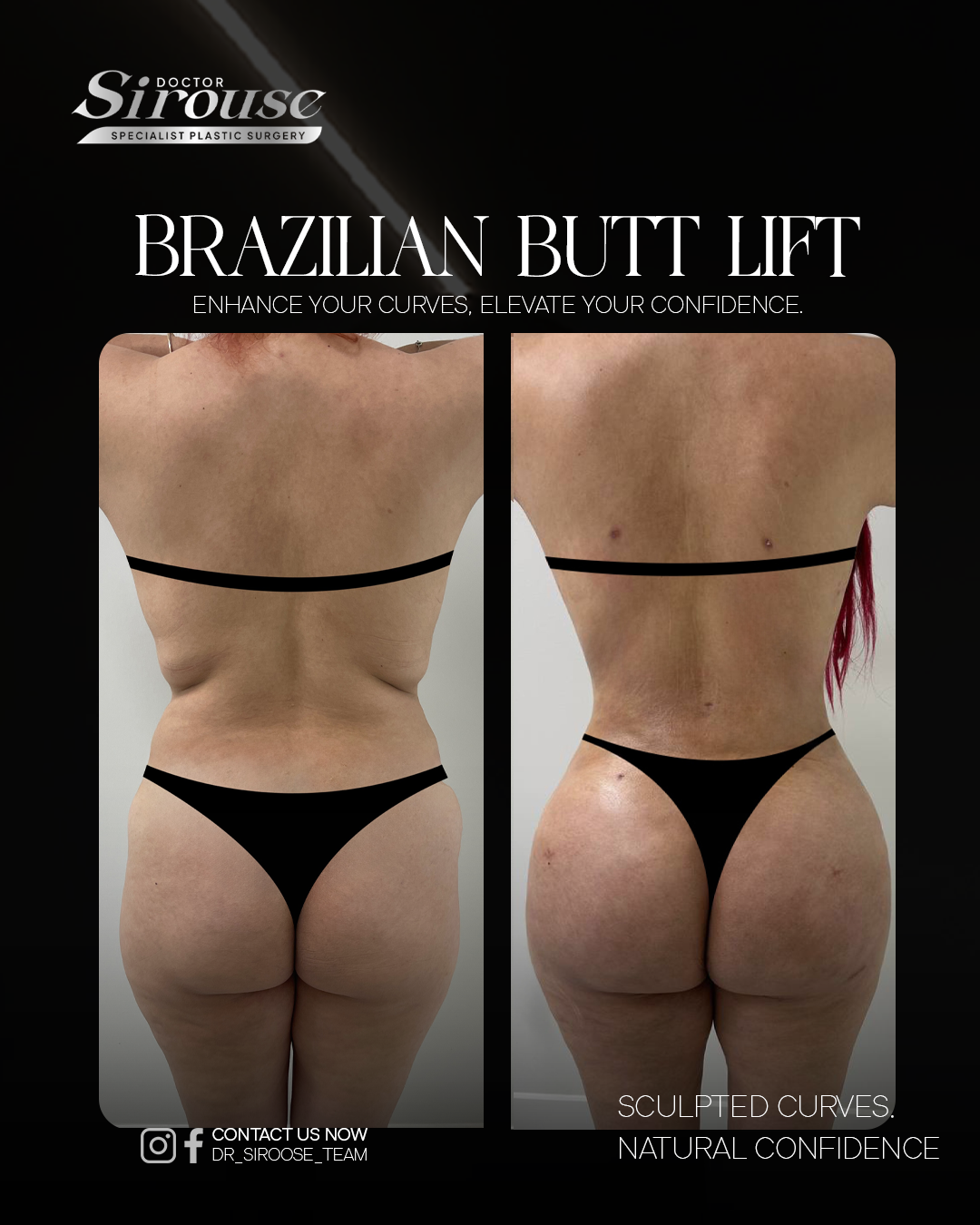 Brazilian butt lift before and after