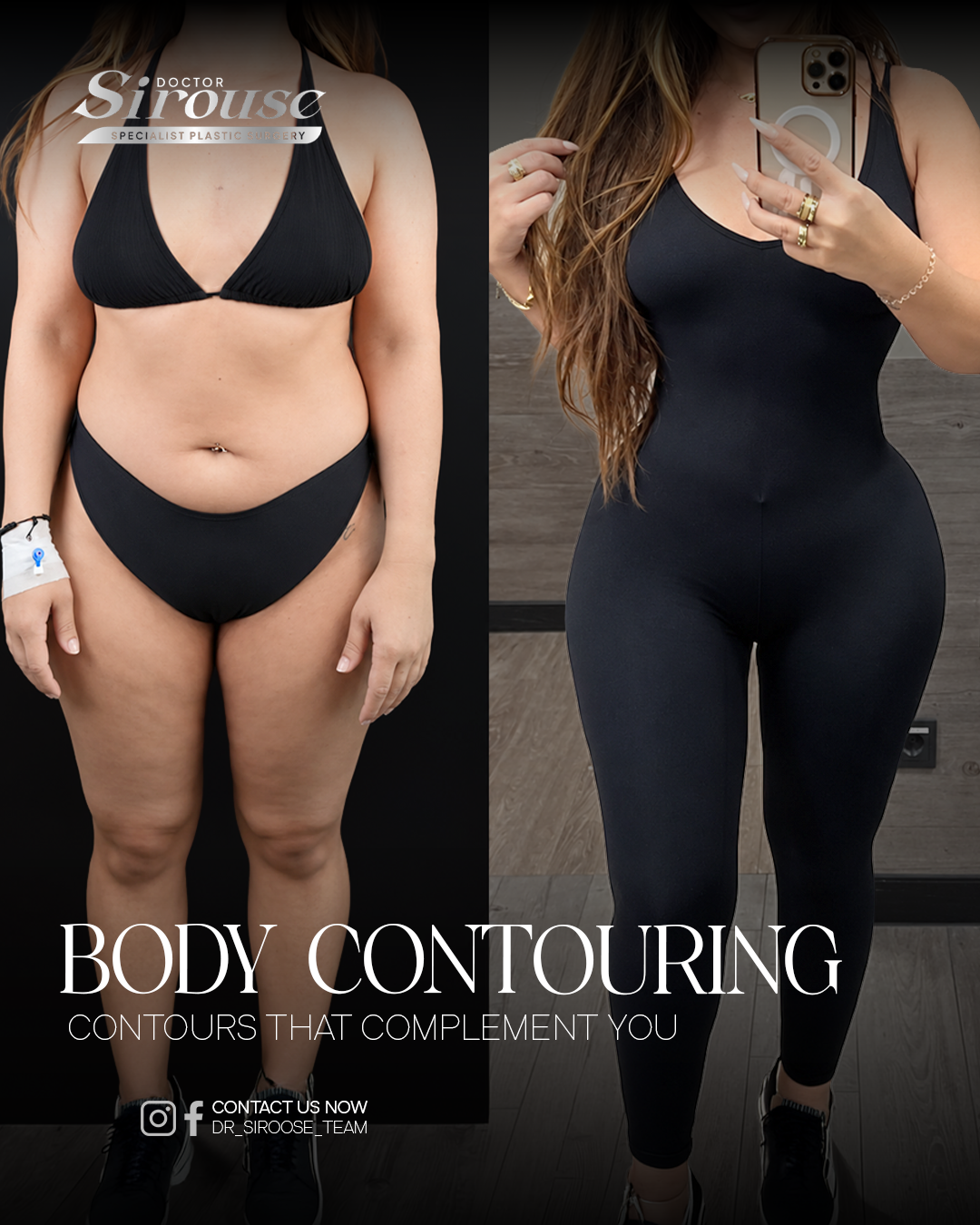 Body contouring before and after — full silhouette