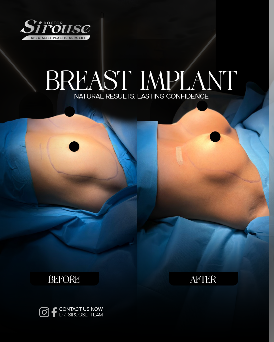 Breast implant before and after, surgical view