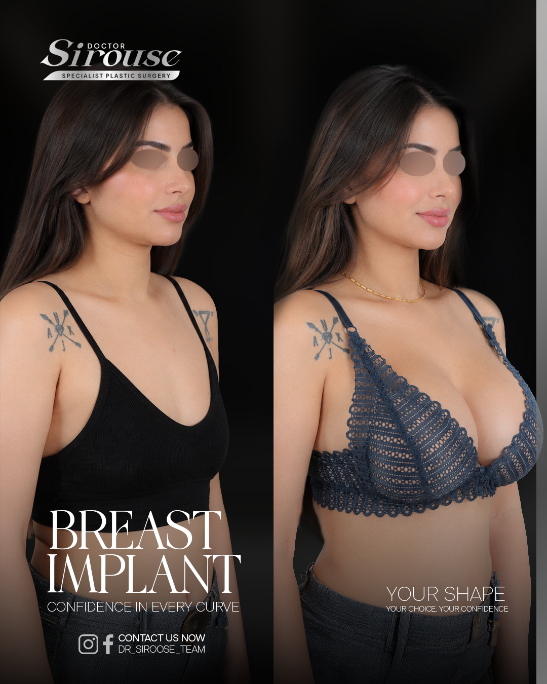Breast implant before and after