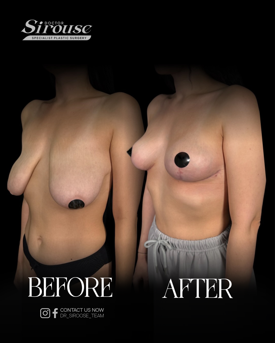 Breast lift before and after