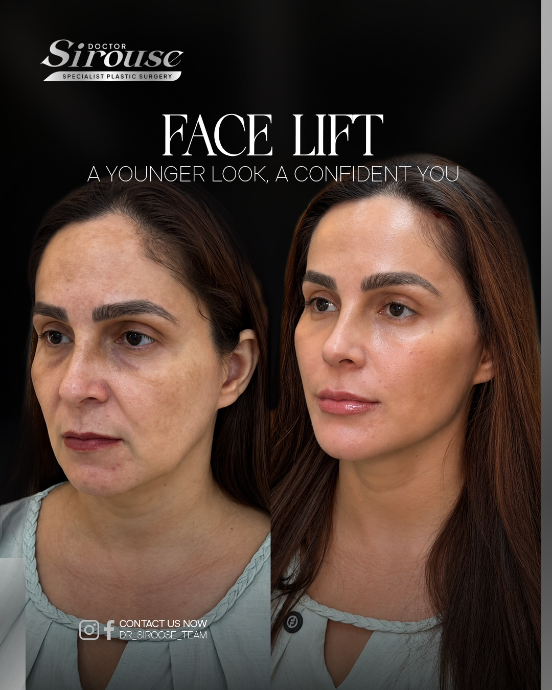Face lift before and after
