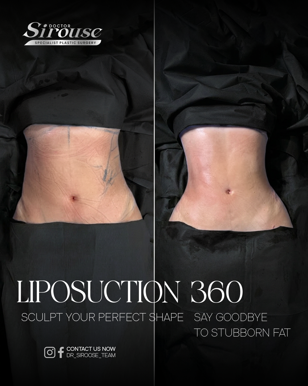 Liposuction 360 before and after — abdomen and waist
