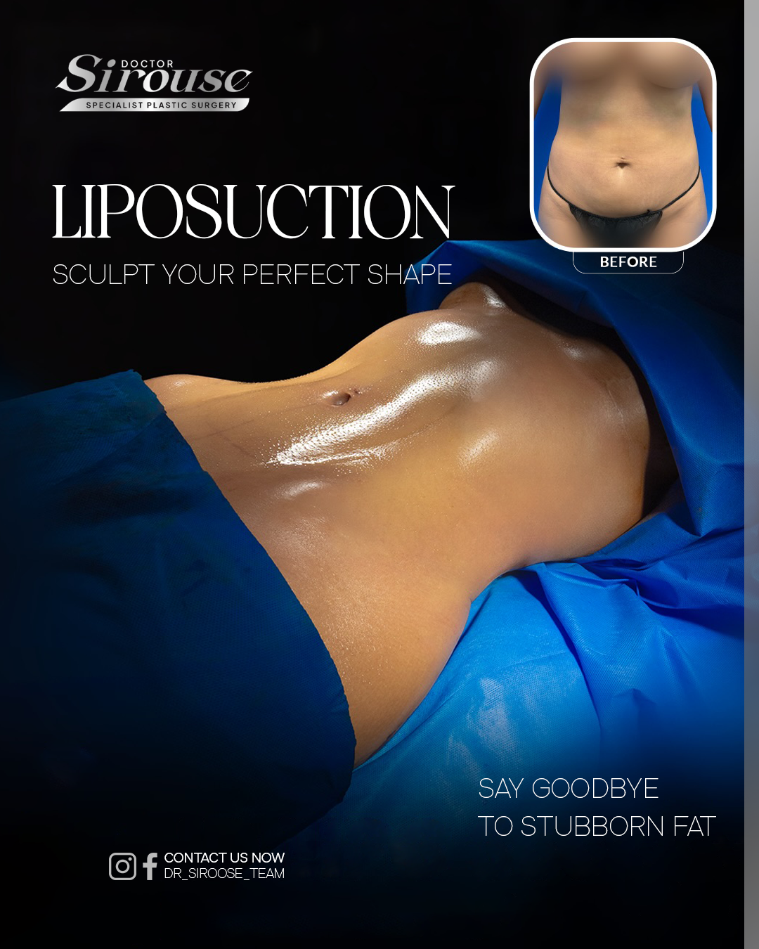 Liposuction result — sculpted abdomen